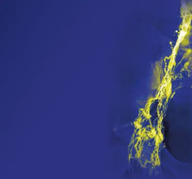 Webinar - Lymphangiography - October 7