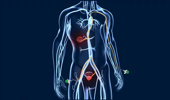 Peripheral Embolization
