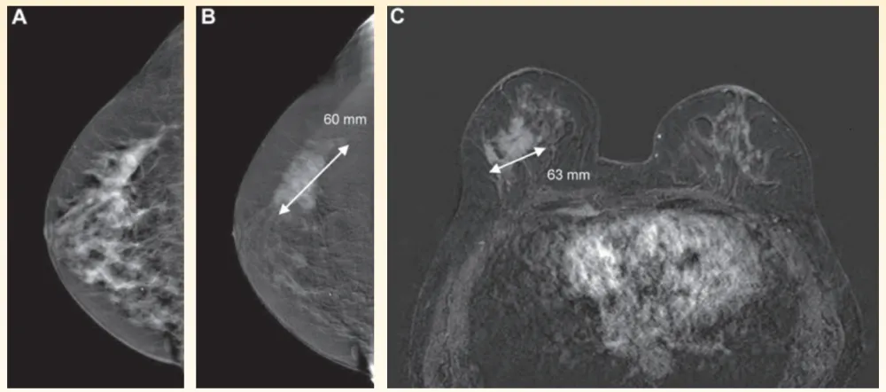 Example of good agreement between tumor diameter measurement between CESM and breast MRI